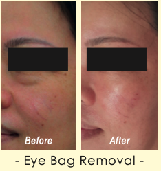 Before and after Eye Bag Removal