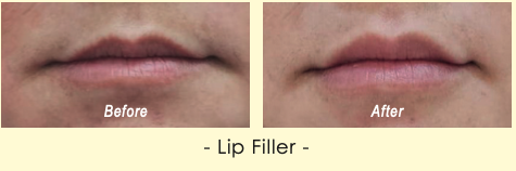 Before and after Lip Filler